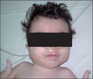 Niña de 11 meses con síndrome de Cornelia de Lange (SCdL) clásico. Obsérvese la facies típica con sinofridia y la oligodactilia bilateral.