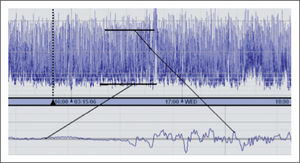 Trazado de electroencefalografía integrada de amplitud discontinuo. La amplitud pico a pico del intervalo interbrote define el margen inferior (amplitud mínima). La amplitud pico a pico de los brotes de onda definen el margen superior (amplitud máxima).