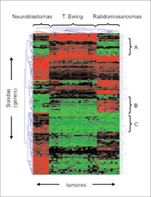 En la figura se muestra un experimento de microarrays realizado con una serie de neuroblastomas, tumores de la familia Ewing y rabdomiosarcomas. Los datos de fluorescencia de cada microarray se procesaron mediante una aplicación informática, lo que da como resultado la imagen que se muestra en la figura. Cada línea vertical corresponde a un tumor y cada línea horizontal, a un gen. Los genes que se expresan a valores elevados en un determinado tumor se muestran en rojo, mientras que los genes que se expresan a valores bajos se muestran en verde. Un análisis estadístico de correlación segrega cada tipo tumoral por separado e identifica grupos de genes que sólo se expresan a valores elevados en tumores de Ewing (grupo A), rabdomiosarcomas (grupo B) o neuroblastomas (grupo C), y que pueden, por tanto, servir para definir mejor a estas entidades desde un punto de vista molecular.