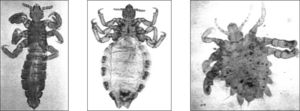 Agentes causantes de las pediculosis en humanos. Pediculus humanus capitis (izquierda), Pediculus humanus corpiris (centro), Phthirus pubis (derecha).