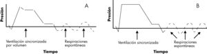 A: SIMV por volumen, curva de presión-tiempo. B: SIMV por presión, curva de presióntiempo. SIMV: ventilación mandatoria intermitente y sincronizada.
