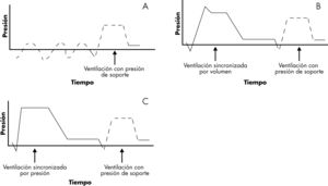A: presión de soporte, curva de presión-tiempo. B: SIMV por volumen más presión de soporte, curva de presión-tiempo. C: SIMV por presión más presión de soporte, curva de presión-tiempo. SIMV: ventilación forzada intermitente y sincronizada.