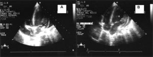 A: proyección eco-2D de 4 cámaras en la que se observa derrame pericárdico que produce taponamiento cardíaco con colapso de la aurícula derecha (AD). Obsérvese la forma cóncava de la pared libre auricular (flechas). B: tras la pericardiocentesis desaparecen los signos de colapso auricular. AI: aurícula izquierda; DP: derrame pericárdico; VD: ventrículo derecho; VI: ventrículo izquierdo.
