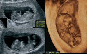 A. Imagen en ecografía bidimensional de un embrión de 10 semanas, para observar la medición de la CRL (crown rump length). B. Ecografía tridimensional del mismo embrión. Entre las marcas, se observa la longitud cráneo-cóccix.