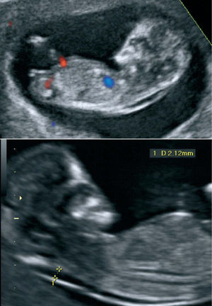 A y B. Traslucencia nucal. Cortes sagitales fetales en las semanas 11–14 para observar la medición de la translucencia nucal, que debe hacerse con el máximo aumento posible.