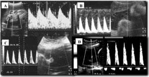 Doppler en arteria umbilical. Secuencia de patrones con disminución de flujo diastólico. A. Patrón normal con flujo diastólico evidente. B. Aumento de resistencia vascular, donde se aprecia flujo diastólico reducido pero todavía presente. C. Ausencia de flujo diastólico. D. Inversión de flujo diastólico o aparición de flujo reverso.