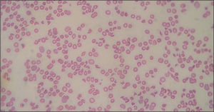 Extensión de sangre periférica donde se aprecia hemólisis intensa.