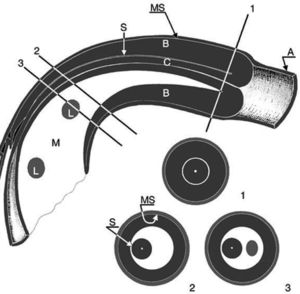 Esquema ecográfico de una invaginación mostrando un corte longitudinal y 3 axiales. Se identifican 3 paredes de asas y el mesenterio. El intussuscipiens (A) contiene las 2 porciones del intussusceptum: la porción que regresa evertida (B), que está engrosada, y la porción entrante (C), que se localiza en el centro de la invaginación rodeada por el mesenterio en forma de semiluna (M) (signo de crescent en “donut” en 2). El mesenterio contiene algunas adenopatías (L). MS: Superficies mucosas enfrentadas de A y B; S: superficies serosas en contacto de ambas porciones del intussusceptum. Con permiso del Dr. Del Pozo (Radiographics).