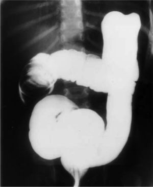 Imagen típica en “muelle” producida por el enema de bario intoduciéndose entre las superficies mucosas enfrentadas del intussuscipiens y del intussusceptum. Con permiso del Dr. Del Pozo (Radiographics).