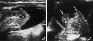 Secuencia de la reducción de una invaginación mediante enema de suero salino guiada por ecografía. (A). El líquido anecoico (negro) del enema en el colon rodea el intussusceptum, lo separa del intussuscipiens (fina pared del colon que contiene el enema) y lo empuja hasta la válvula ileocecal (B), pasando finalmente el intussusceptum a través de ella. Labios de la válvula ileocecal (flechas). Con permiso del Dr. Del Pozo (Radiographics).