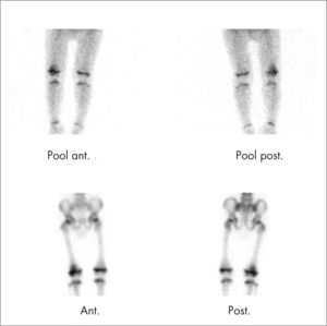 Gammagrafía ósea con HDP 99mTc: fase de pool vascular y fase metabólica con hipercaptación en la epífisis distal del fémur derecho compatible con osteomielitis.
