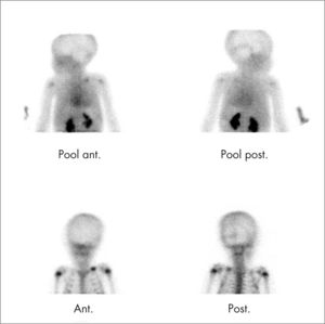 Niño con inmovilidad del brazo izquierdo tras caída. Radiología normal. Gammagrafía ósea con HDP 99mTc: ambas fases del estudio muestran un aumento de captación del trazador en el tercio medio de clavícula izquierda compatible con fractura.