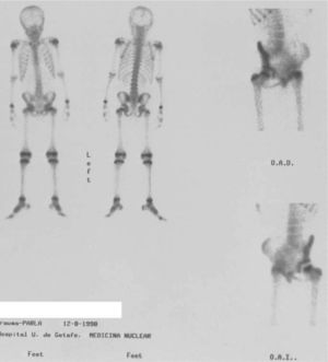 Gammagrafía ósea que demuestra ausencia de visualización de la cabeza femoral izquierda compatible con enfermedad de Perthes.