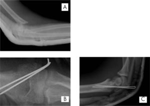 Fractura supracondílea (A), reducida y fijada percutáneamente con 2 agujas de Kirschner laterales (B y C).