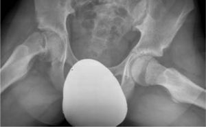 Epifisiólisis de la cabeza femoral derecha.