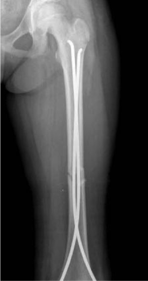 Fractura diafisaria de fémur tratada mediante enclavado intramedular elástico.