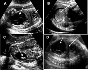 Quistes ováricos fetales. A) Corte sagital de un feto de 32 semanas de gestación. La flecha corta señala la silueta cardíaca; la flecha larga delimita una tumoración quística ovárica con límites bien delimitados y seudotabiques en su interior. B) Quiste de ovario de un feto hembra de 30 semanas de gestación. La flecha señala su contenido hemorrágico. C) Quiste ovárico de un feto de 34 semanas con contenido sólido (flecha). D) Debajo del diafragma (flecha larga) se dibuja una tumoración ovárica fetal eminentemente quística (flecha corta) con contenido semisólido en su interior, que se hace más evidente en las zonas más declives.