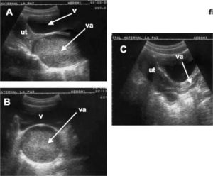 Himen imperforado. Hematocolpos. A) Corte sagital del aparato genital de una niña de 13 años. En primer término, a la izquierda, se observa el útero (Ut) y a la derecha la vejiga (V). En el centro se aprecia la vagina (va) abultada y distendida con un contenido líquido denso y puntiforme (sangre menstrual). B) Corte transversal de la vagina distendida (va) por debajo de la vejiga (V). C) Imagen ecográfica sagital posterior a la perforación quirúrgica del himen en la que se aprecia un útero y vagina normales.