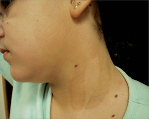 Dermatitis de berloque inducida por colonias.