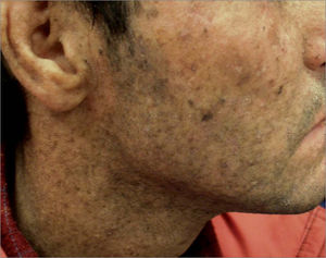 Xeroderma pigmentoso.