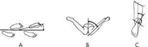 Perfil rotacional. A: Angulo de progresión de la marcha. B: Rotación interna de la cadera. C: Ángulo muslo-pie.