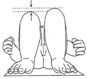 Signo de Galeazzi: en decúbito supino se flexionan las caderas y las rodillas sin apoyar los pies en la cama. En este caso se observa un acortamiento del muslo derecho que indica que la cadera derecha está luxada.