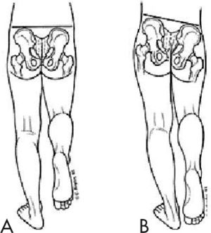 Signo de Trendelenburg. A: Cadera normal; B: El signo de Trendelenburg pone en evidencia en este caso una insuficiencia de la musculatura abductora de la cadera izquierda.