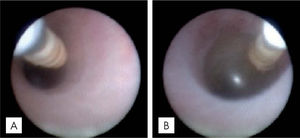 Hernia diafragmática congénita (fetoscopia). A. Balón desinflado. B. Balón lleno (Dr. Peiró, Vall d´Hebron).