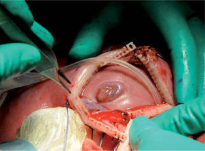 Corrección prenatal de un mielomeningocele mediante cirugía fetal abierta. Histerotomía y exposición del defecto fetal. (Dr. Peiró, Vall d'Hebron.)