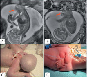 Teratoma sacrococcígeo. A. Sagital SSFSE T2. B. Sagital FIESTA. Edad gestacional de 20 semanas. Masa sacrococcígea sin componente presacro. C. Cesárea en la semana 36. Fotografía neonatal del teratoma antes de la cirugía. D. Fotografía neonatal tras cirugía en las primeras 48h.