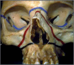 Trayectos de las fracturas tipo Le Fort.