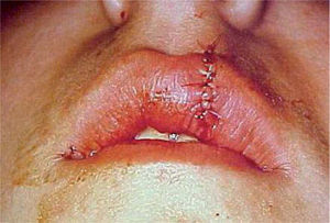 Sutura labial.