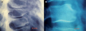 Enfermedad de Scheuermann dorsal (acuñamiento típico) y lumbar (aspecto de muesca).