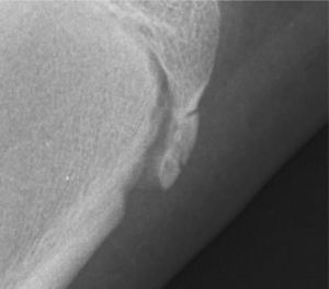 Tuberosidad tibial anterior con un aspecto semifragmentado e irregular.