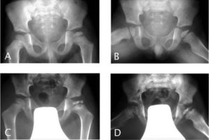 Evolución en un caso de enfermedad de Perthes. A y B: radiografías iniciales grado II-III. C y D: radiografías a los 7 meses: grado IV con signos de riesgo.
