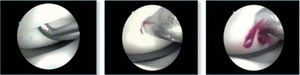 Aspecto artroscópico de la osteocondritis: baja consistencia a la palpación; sangrado tras las perforaciones.