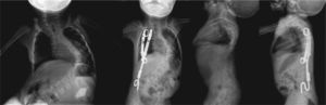 Paciente de 3 años con escoliosis neuromuscular tratada mediante un distractor torácico (VEPTR)