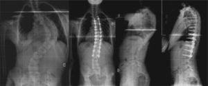 Paciente de 15 años con escoliosis idiopática del adolescente, dorsal derecha de 86°, tratado mediante fusión posterior y tornillos pediculares T4-L2.