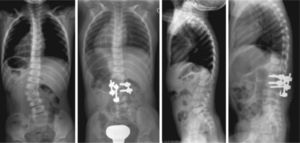 Paciente de 3 años de edad afectada de escoliosis por malformación congénita tratada mediante resección de la hemivértebra (vía posterior) e instrumentación de titanio.