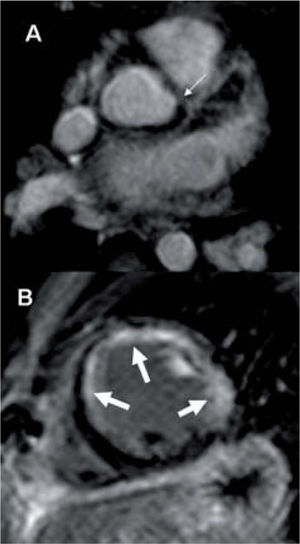 Paciente intervenido de coronaria anómala mediante reimplantación quirúrgica. En la secuencia eco de gradiente 3D (A) se observa la estenosis severa en el origen de la coronaria izquierda (flecha fina). El estudio de realce tardío en el eje corto cardíaco (B) muestra una extensa captación de contraste subendocárdica y transmural en todo el territorio coronario izquierdo (flechas gruesas).