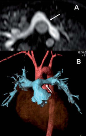 Paciente intervenido de D-transposición de las grandes arterias con cirugía de Jatene. Estenosis moderada de la arteria pulmonar izquierda (flecha) visualizada en la secuencia angiográfica con contraste por RM (A) y en las reconstrucciones volumétricas (B).