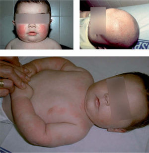 Dermatitis atópica: fase de lactante.