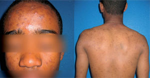 Características clínicas del acné en un paciente de piel negra.