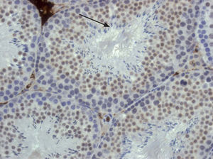 Fotomicrografía de un testículo de ratón generado en nuestro laboratorio para el estudio de la maduración de las espermatogonias (Dra. C. Lavarino). En el testículo, las espermatogonias (células grandes en azul) sufren diversas mitosis y maduran hacia el tipo B de espermatogonia (en marrón en el túbulo seminífero) que son las células que sufrirán el proceso de meiosis para producir las espermátides (flecha; células azules alargadas de menor tamaño).