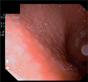 Patrón nodular mucosa gástrica.