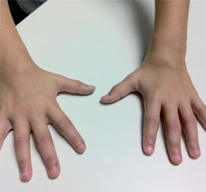 Muñecas e interfalángicas proximales tumefactas en paciente con artritis idiopática juvenil poliarticular.