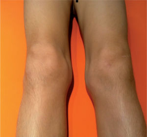 Rodillas tumefactas en paciente con artritis idiopática juvenil poliarticular.