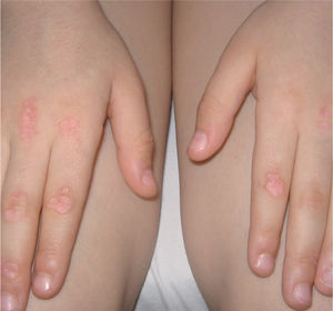 Pápulas de Gottron en paciente con dermatomiositis juvenil.