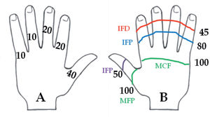 Porcentajes de lesión según el dedo afectado (A) y el nivel donde se produce la lesión (B). IFD: interfalángica distal; IFP (azul): interfalángica proximal; IFP (lila): interfalángica del pulgar; MCF: metacapofalángica; MFP: metacarpofalángica del pulgar.