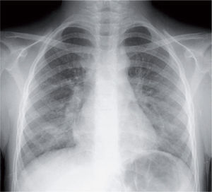 Infiltrado parahiliar peribronquial en una neumonía por Mycoplasma pneumoniae.